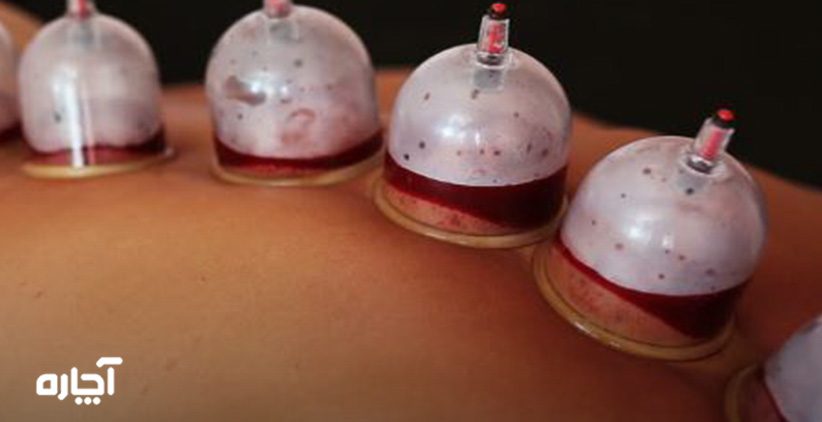 روش انجام حجامت چیست حجامت در منزل حجامت در خانه حجامت در محل