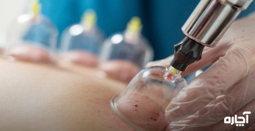 فواید حجامت در منزل چیست حجامت در خانه برای زنان مزایای حجامت در محل