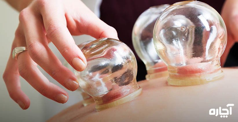 حجامت د ر خانه چگونه انجام می شود حجامت در منزل انجام حجامت در محل