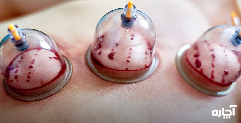 حجامت در منزل چیست خدمات حجامت در خانه 