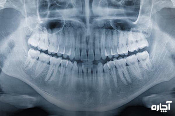 عکس دندان خراب در رادیولوژی چگونه است؟