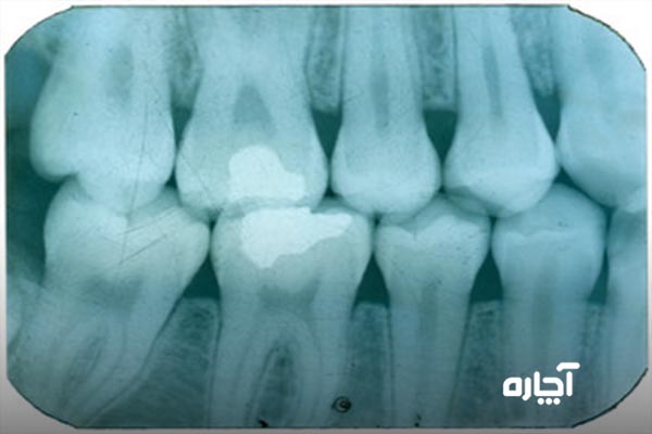 عکس رادیوگرافی دندان خراب چگونه است