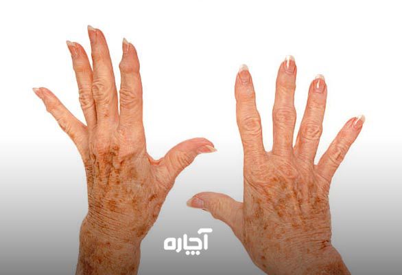 مراقبت از پوست سالمندان چگونه است؟