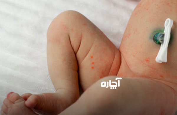 درمان عفونت قارچی مخمری کاندیدا آلبیکنس پوشک نوزاد