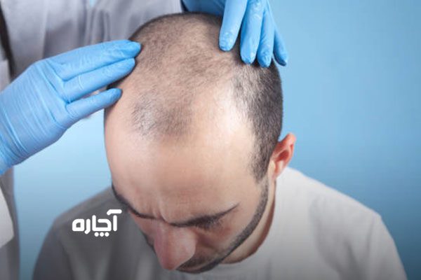 مراقبت های بعد از کاشت مو برای جلوگیری از بین رفتن پیوند مو