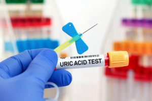 آزمایش اوریک اسید برای چیست 
