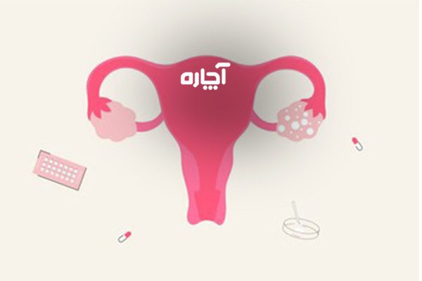 عوارض تنبلی تخمدان بر هورمون‌های آندروژن زنان 