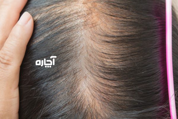 درمان ریزش مو تخمدان پلی کیستیک چگونه است؟
