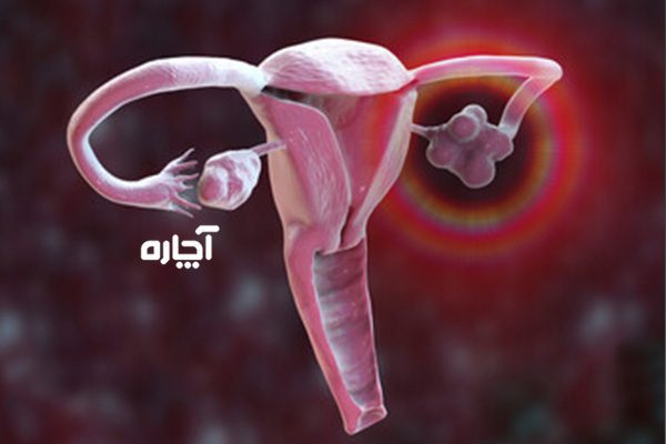 علت اختلالات هورمونی در تنبلی تخمدان 